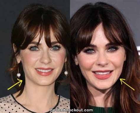 zooey deschanel filler|Zooey Deschanel Plastic Surgery: Has the Actress Had Work Done